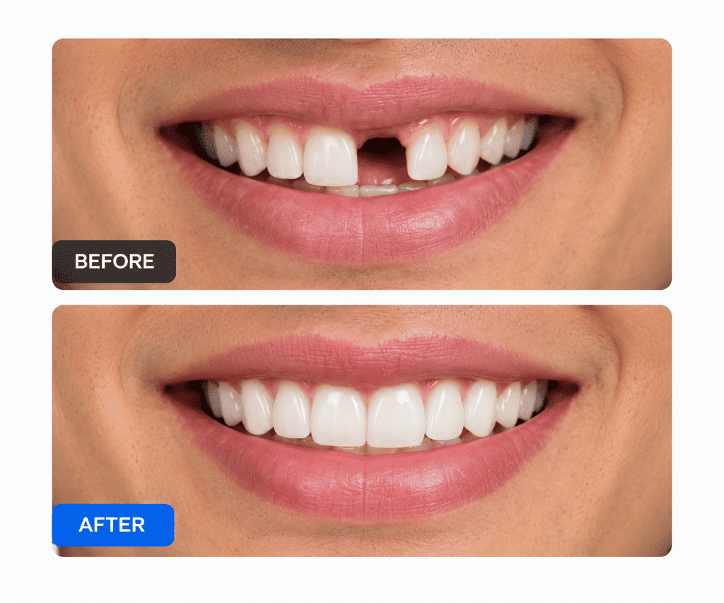 Dental Implants treatment PM Palem Visakhapatnam
