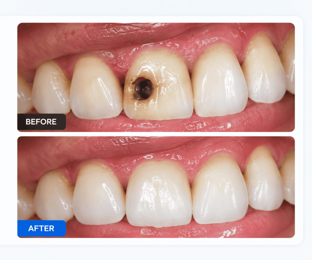 Root Canal Treatment in Pm Palem Visakhapatnam