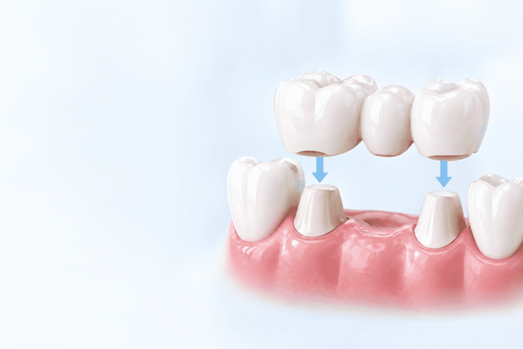Dental crowns and bridges in visakhapatnam