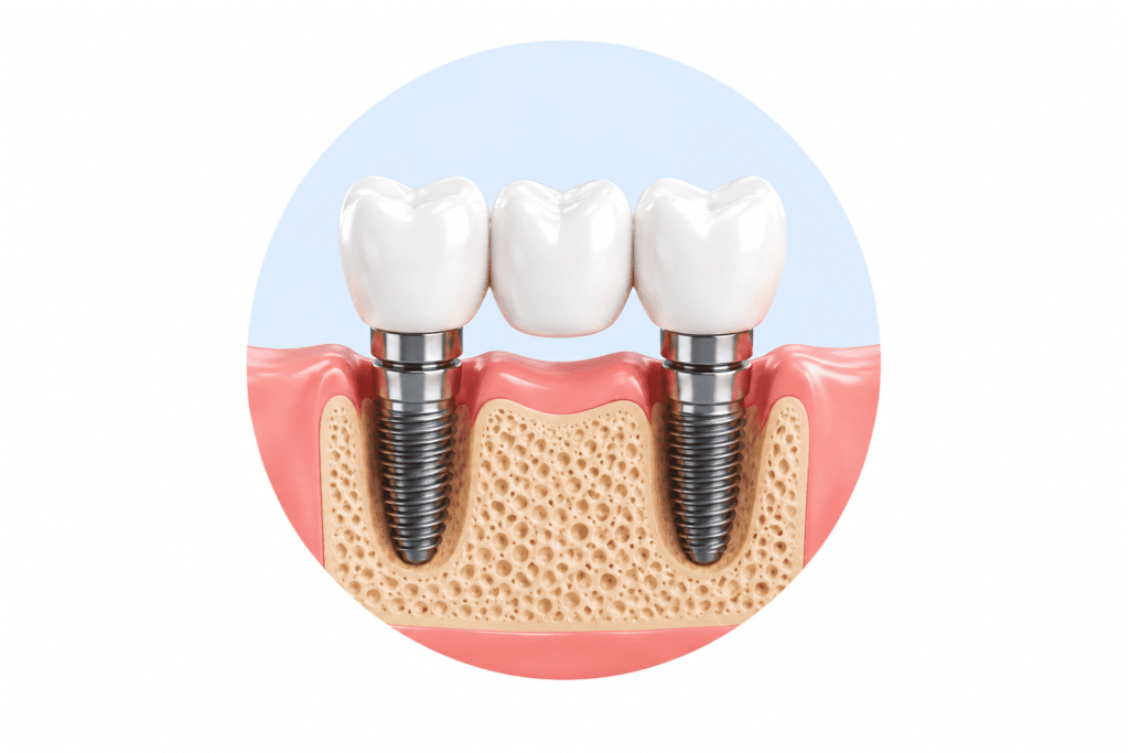 Multiple tooth implants