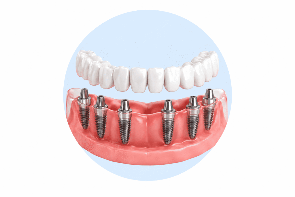 Full-Arched Implants solutions