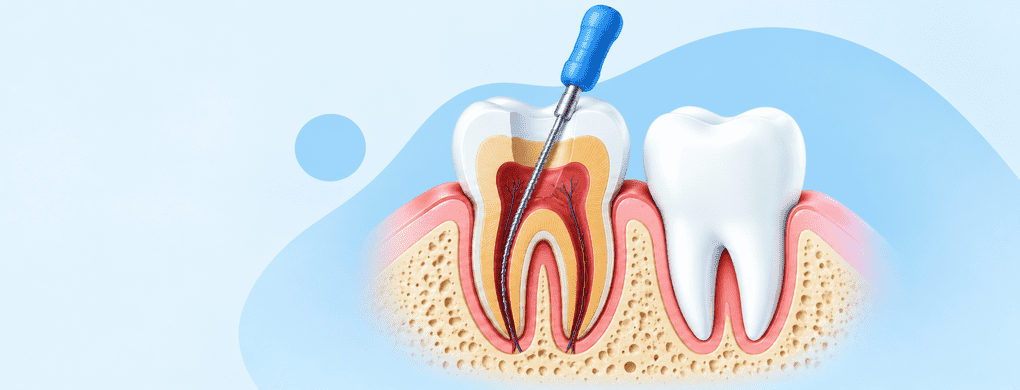 Root Canal Treatment in Visakhapatnam